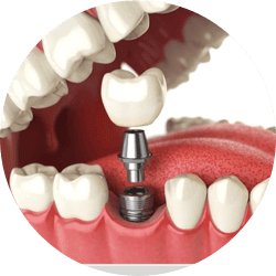 IMPLANTES DENTÁRIOS